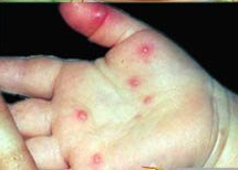 مرض اليدين والقدمين والفم أو الحمى الثلاثية