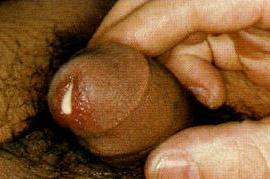 gono