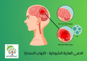 الحمى المخية الشوكية - التهاب السحايا